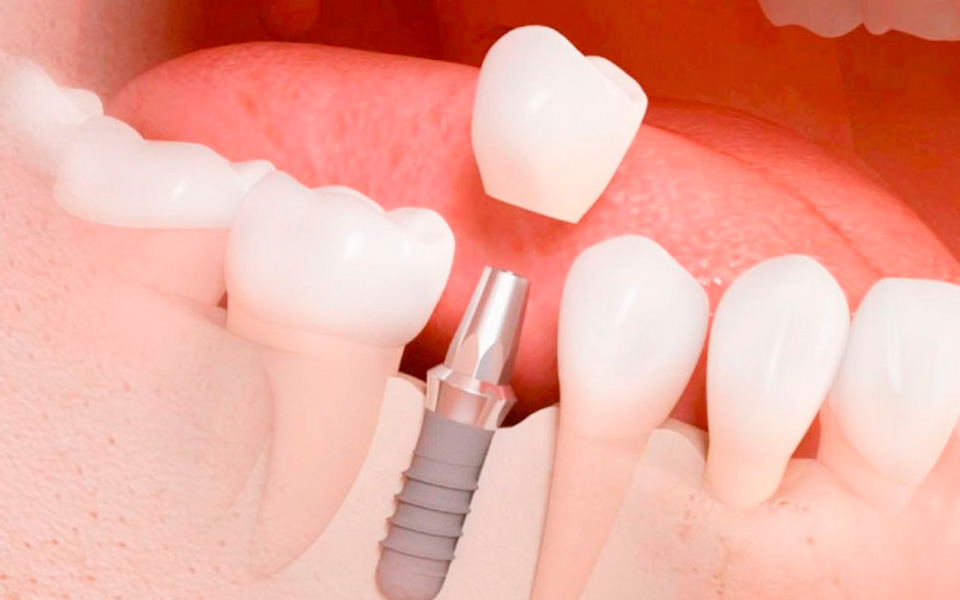 Lee más sobre el artículo 🦷 ¿Qué son los implantes dentales?
