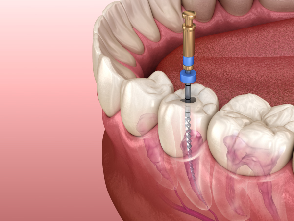 En este momento estás viendo 🦷 Endodoncia – Clinica Dental en Santander