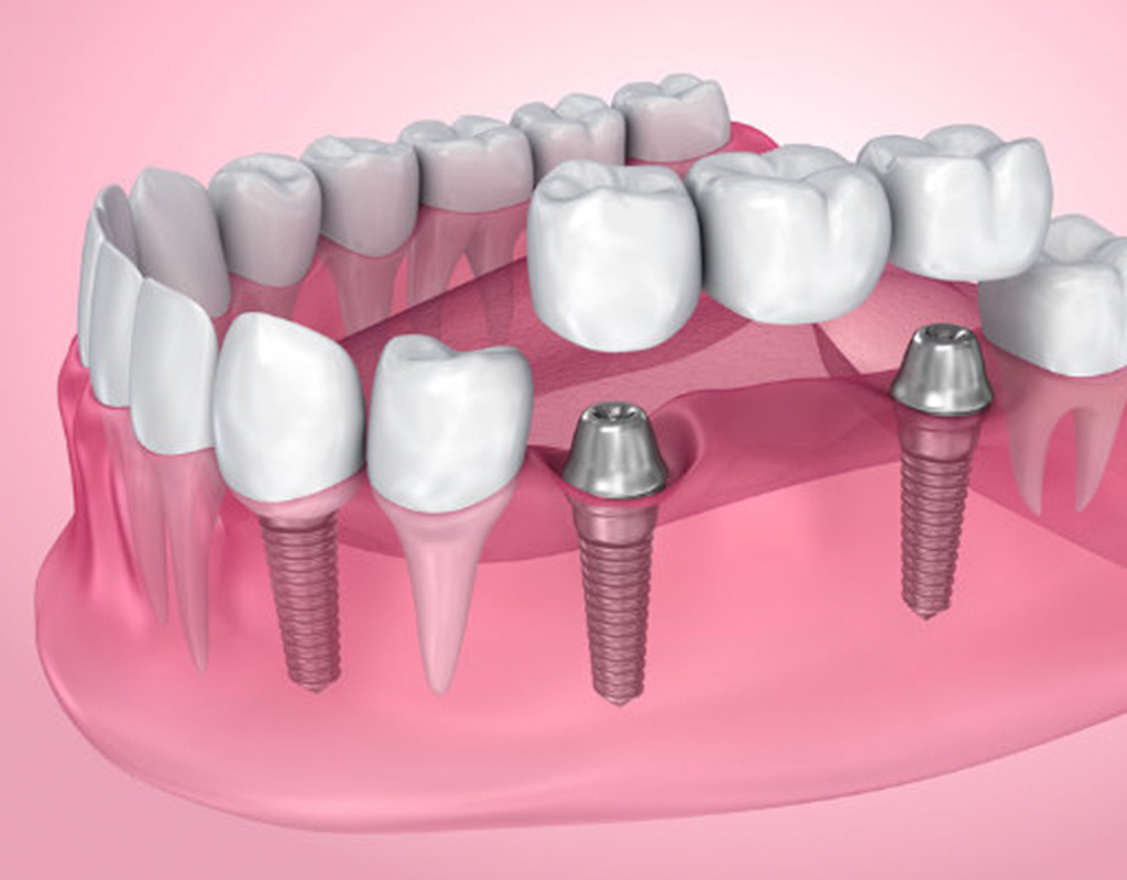 En este momento estás viendo 🦷 Implantes dentales de carga inmediata en Santander