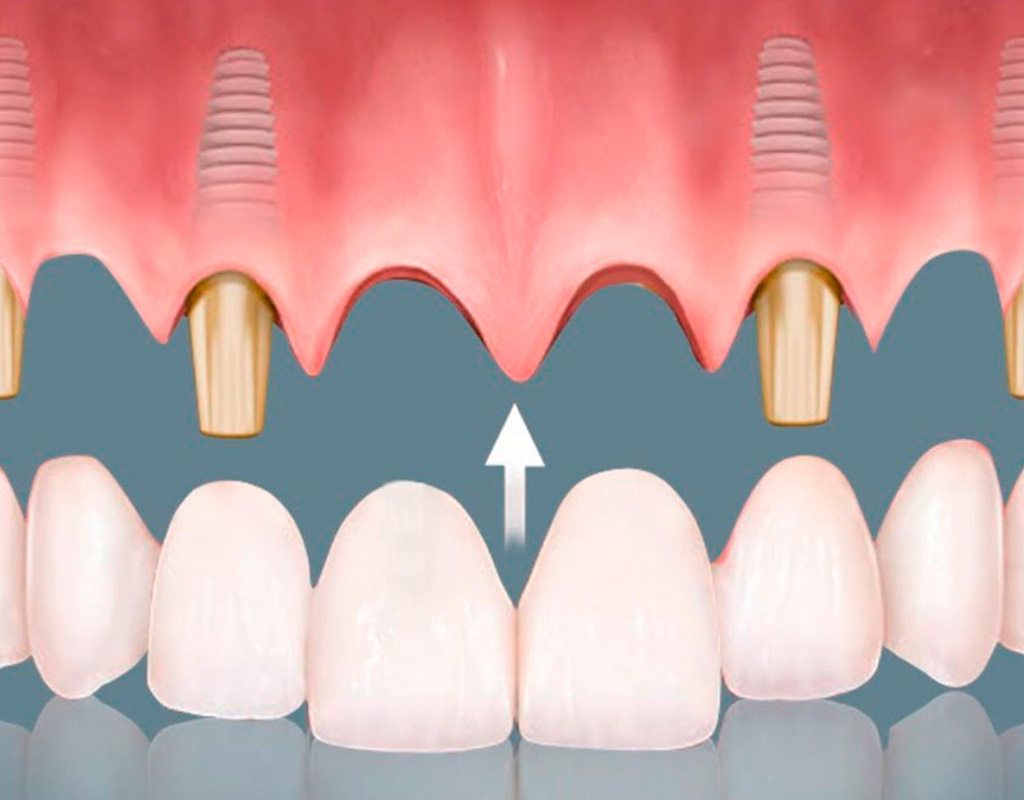 Lee más sobre el artículo 🦷 Prótesis Dentales en Santander