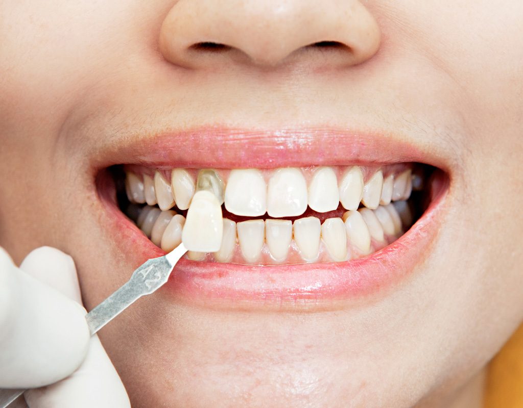 Lee más sobre el artículo 🦷 Carillas Dentales en Santander