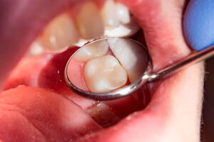 Lee más sobre el artículo 🦷 Terceros molares o «Muelas del  Juicio»
