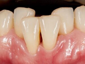 Lee más sobre el artículo 🦷 Qué es y cómo corregir el Apiñamiento Dental en Santander