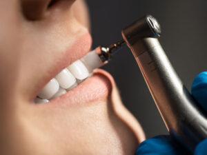 Lee más sobre el artículo 🦷 Limpieza dental en Santander