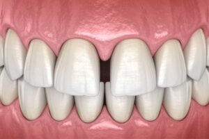 Imagen Diastema - Clínica Dental Teresa Ortega
