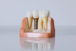 Lee más sobre el artículo 🦷 ¿Cuánto duran los implantes dentales?