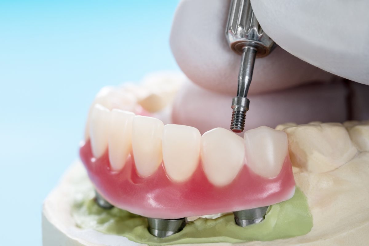 Colocación de implantes dentales en un día - Clínica Dental Teresa Ortega