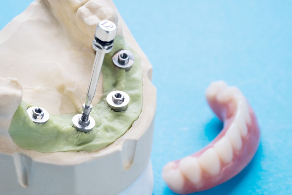 Lee más sobre el artículo 🦷 Colocación de implantes dentales en un día