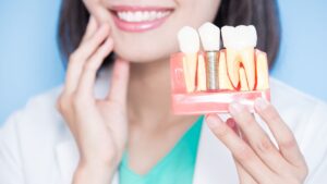 Lee más sobre el artículo 🦷 Dentista para pacientes con implantes dentales en Santander
