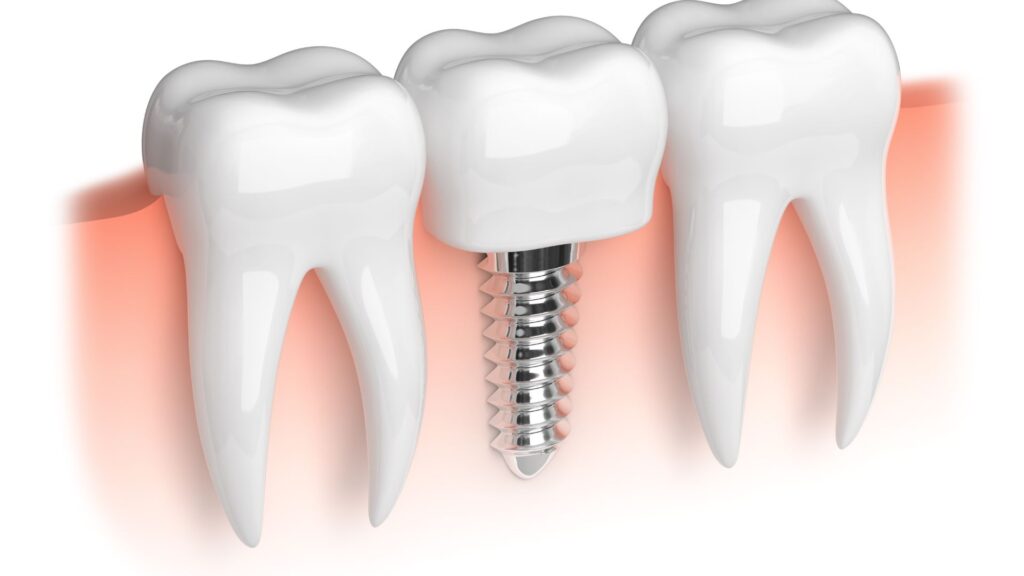 Dentista para pacientes con implantes dentales en Santander