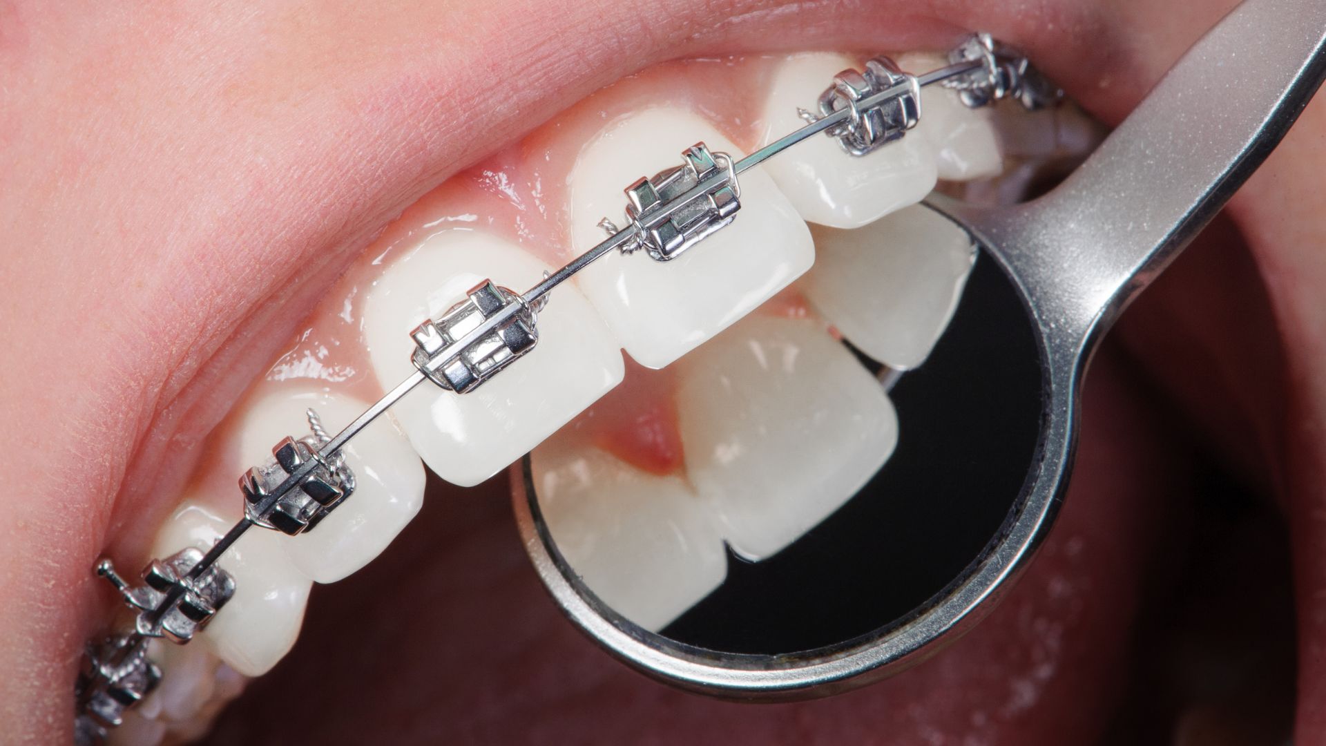 Lee más sobre el artículo 🦷 Dentista para pacientes con ortodoncia en Santander